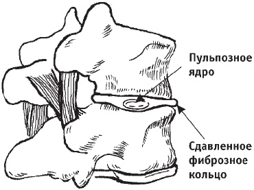 Первая скрипка позвоночника. Революционная методика лечения остеохондроза