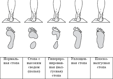 Плоскостопие