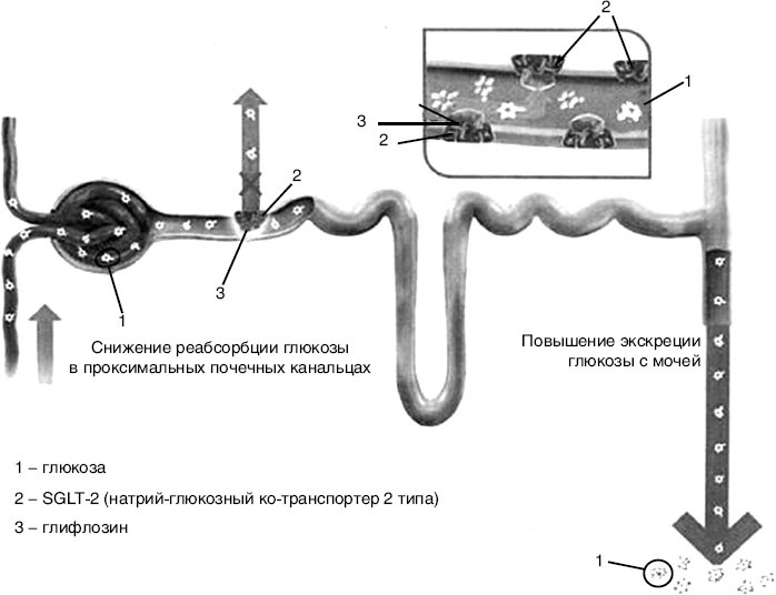 Сахарный диабет