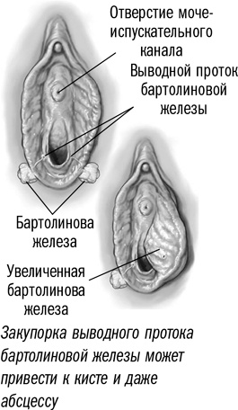 Бартолинит: ФОТО, симптомы, ЛЕЧЕНИЕ | Курортная Клиника Женского Здоровья