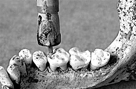 Из истории зубоврачевания, или Кто лечит зубы монархам