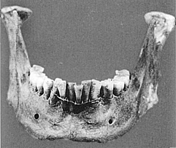 Из истории зубоврачевания, или Кто лечит зубы монархам