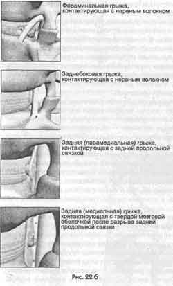 Победить боль в спине