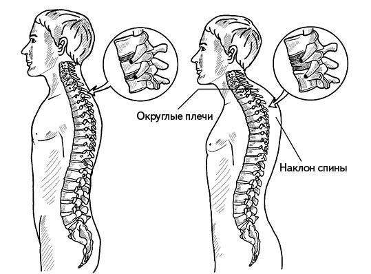 Жизнь без боли в спине. Лечение сколиоза, остеопороза, остеохондроза, межпозвонковой грыжи без операции