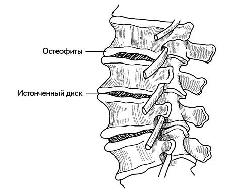 Жизнь без боли в спине. Лечение сколиоза, остеопороза, остеохондроза, межпозвонковой грыжи без операции