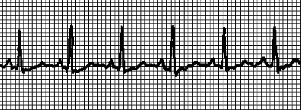 Стоп-инфаркт. Как читать ЭКГ и заботиться о сердце