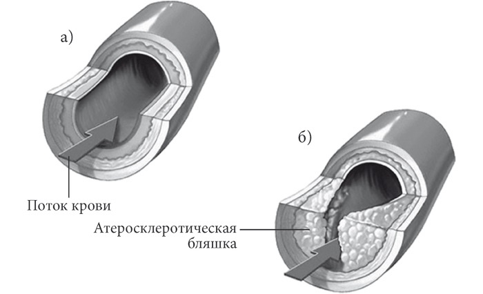 Лучшие методы лечения и профилактики инфаркта миокарда