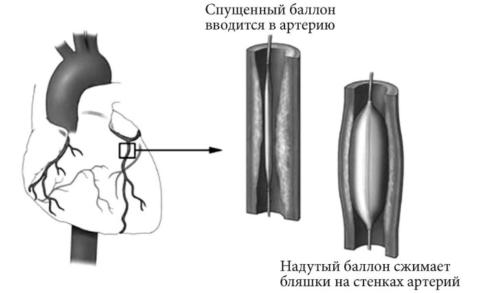 Лучшие методы лечения и профилактики инфаркта миокарда