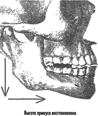 Естественное лечение кариеса. Реминерализация и восстановление зубов при помощи питания