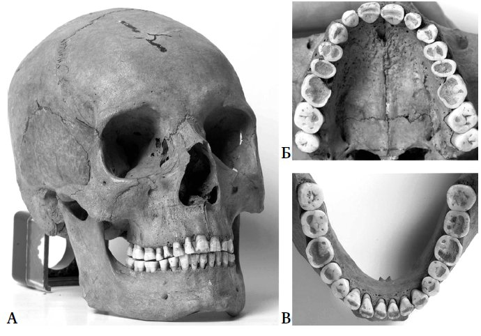 Укус эволюции. Откуда у современного человека неправильный прикус, кривые зубы и другие деформации челюсти