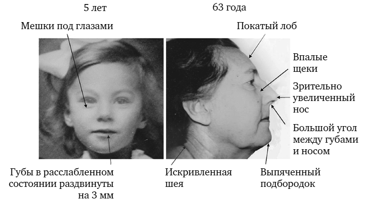 Укус эволюции. Откуда у современного человека неправильный прикус, кривые зубы и другие деформации челюсти