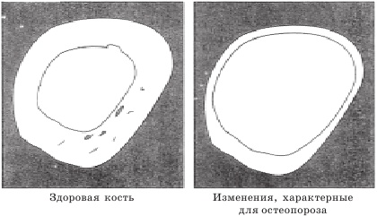 Иллюстрация к книге — Остеопороз. Тихая эпидемия XXI века [Autogen_eBook_id2.jpg]