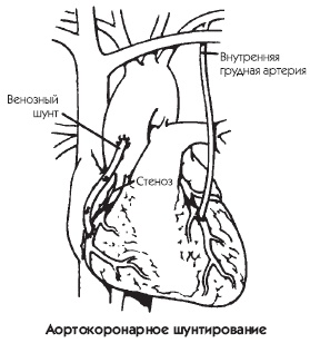 Заболевания сердца и сосудов. Профилактика и лечение
