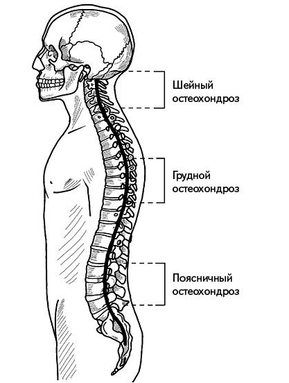 Иллюстрация к книге — Жизнь без боли в спине. Лечение сколиоза, остеопороза, остеохондроза, межпозвонковой грыжи без операции [i_070.jpg]