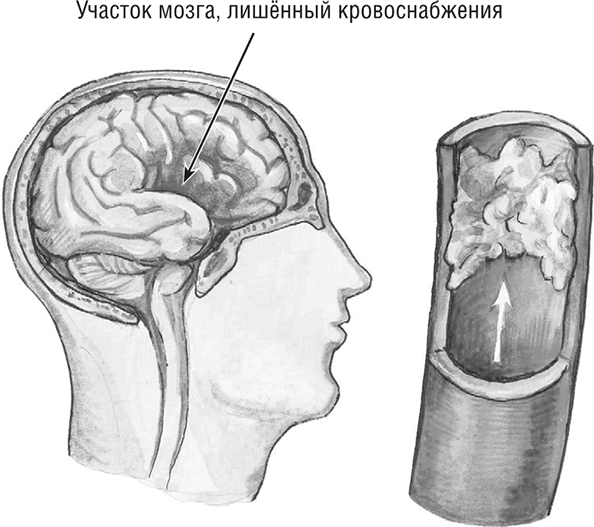 Иллюстрация к книге — Хрупкий мозг. Инсульту не быть? [img_14.jpg]