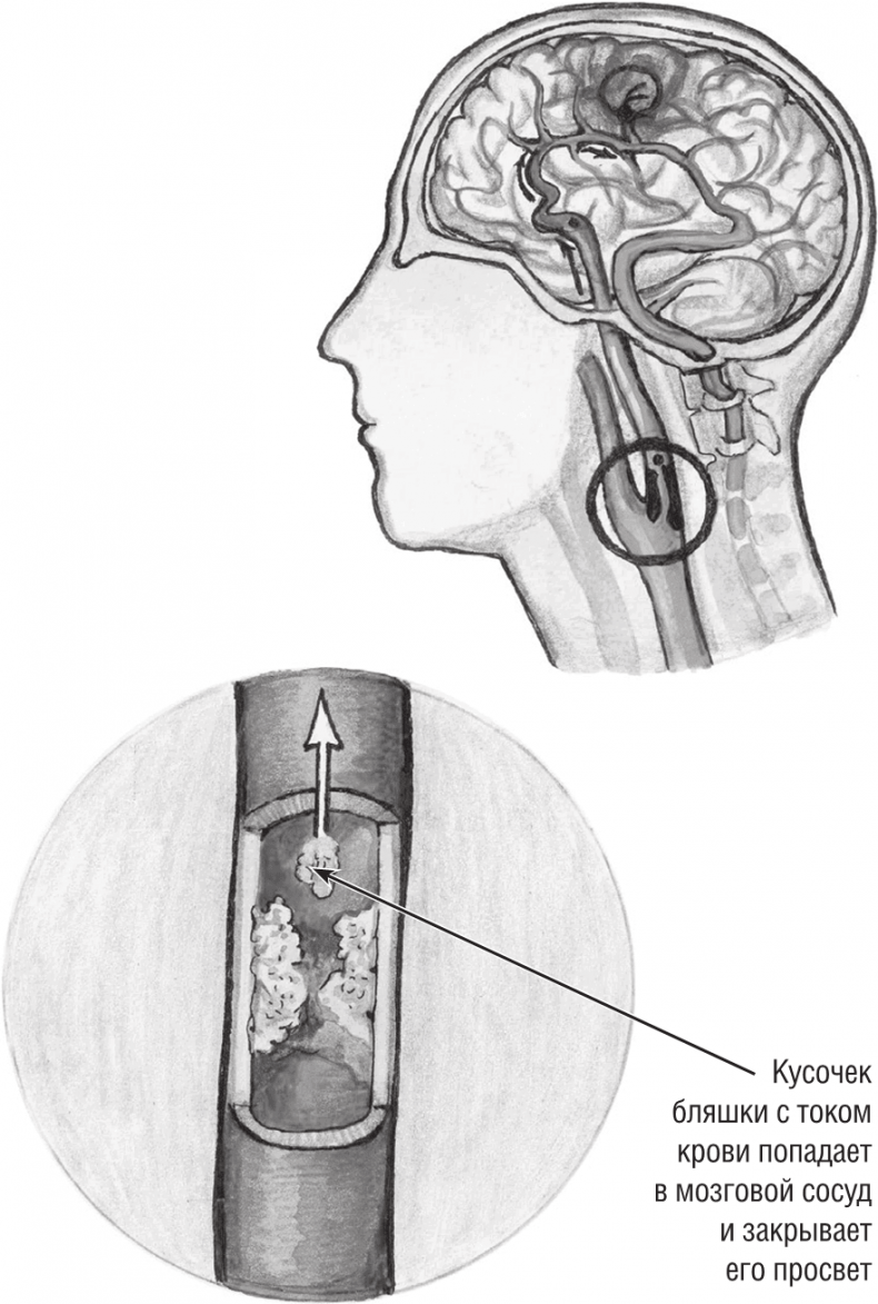 Иллюстрация к книге — Хрупкий мозг. Инсульту не быть? [img_17.jpg]