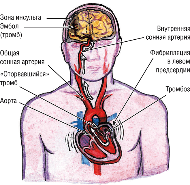 Иллюстрация к книге — Хрупкий мозг. Инсульту не быть? [img_19.jpg]