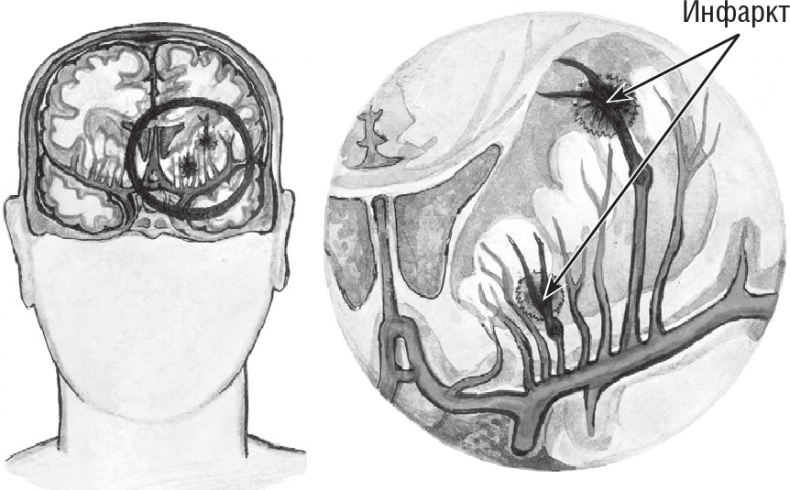 Иллюстрация к книге — Хрупкий мозг. Инсульту не быть? [img_20.jpg]