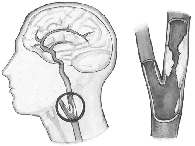 Иллюстрация к книге — Хрупкий мозг. Инсульту не быть? [img_36.jpg]