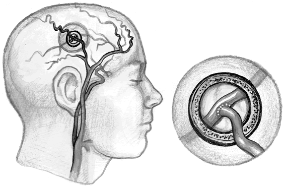 Иллюстрация к книге — Хрупкий мозг. Инсульту не быть? [img_53.jpg]