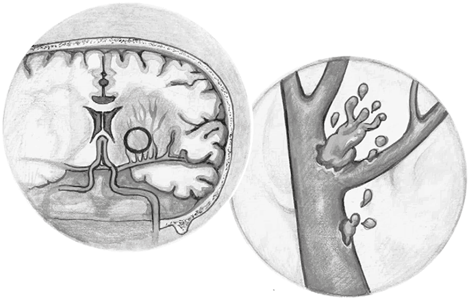 Иллюстрация к книге — Хрупкий мозг. Инсульту не быть? [img_57.jpg]